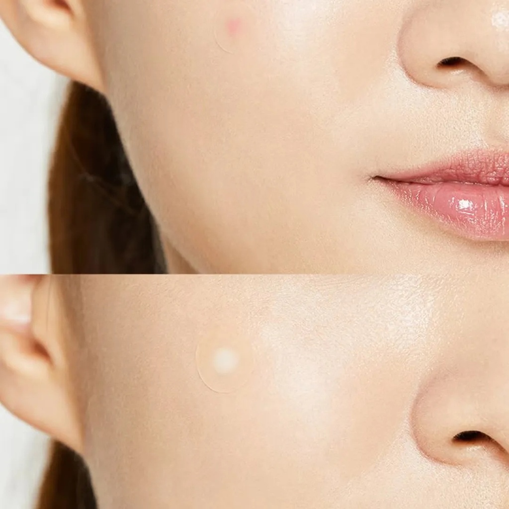 Cosrx Acne Pimple Master Patch 24 piecesA